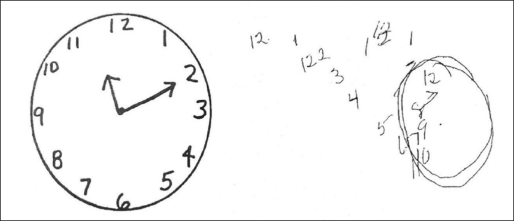 Left: Drawing of accurate analog clock, right: anosognosia patient's drawing does not resemble a clock 